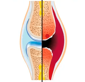 La structure d'une articulation saine et usée avec la désignation du tissu cartilagineux et du liquide synovial